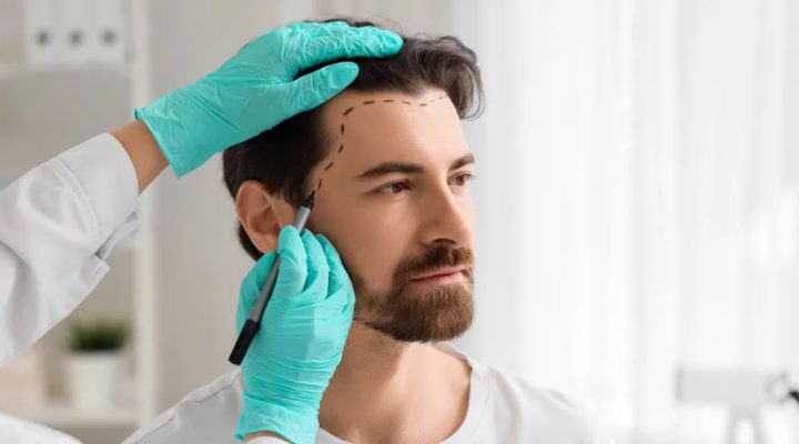Male patient with dotted surgical hairline markings during a cosmetic procedure; clinician in teal gloves marks the scalp with a pen.