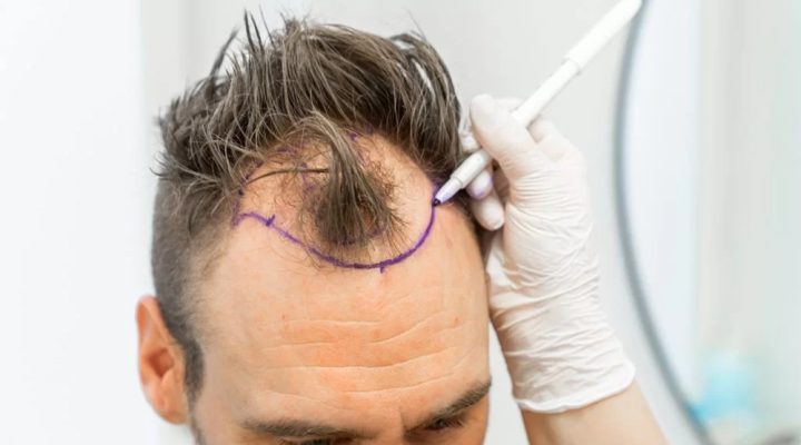 Man's scalp is being marked for a hair transplant; purple lines outline the hairline while a clinician marks with a pen.