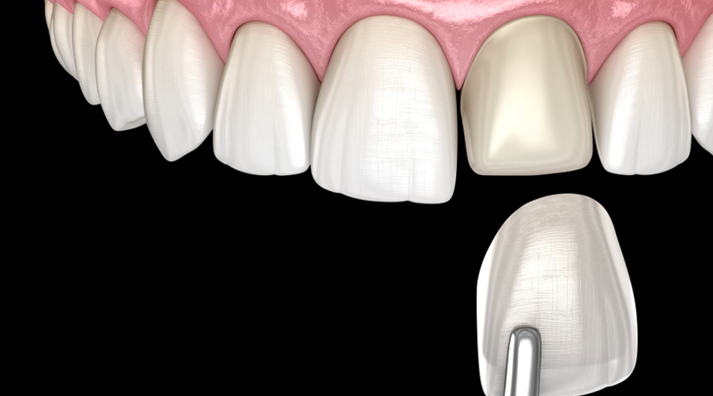 Close-up dental illustration of upper front teeth with a veneer prepared for the central incisor and a tool positioning it