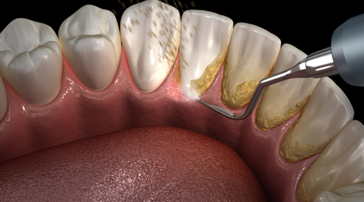 Close-up of a dental scaler removing tartar from the lower teeth at the gumline.