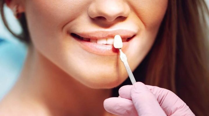 Faccette Dentali in Turchia