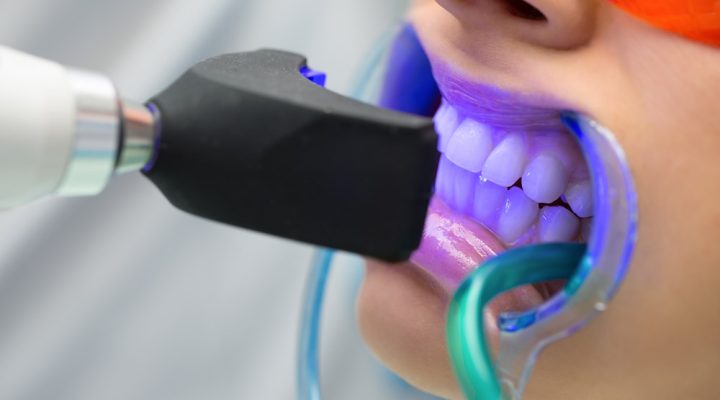 How Much Does Teeth Whitening Cost?